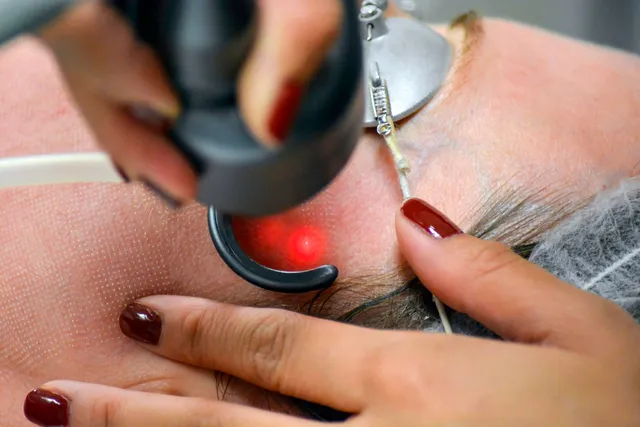 Laser Treatments