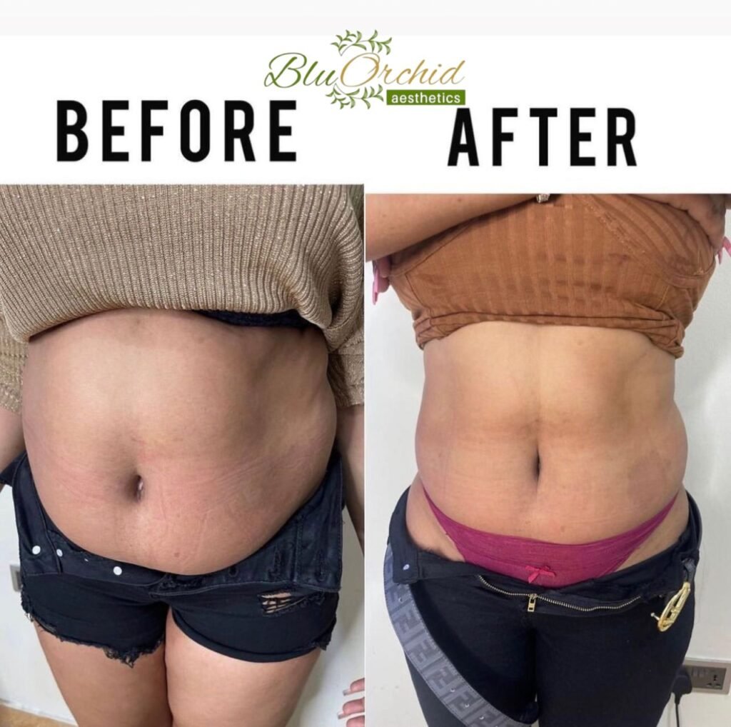 Weight loss programme progress, BluOrchid Aesthetics Lekki