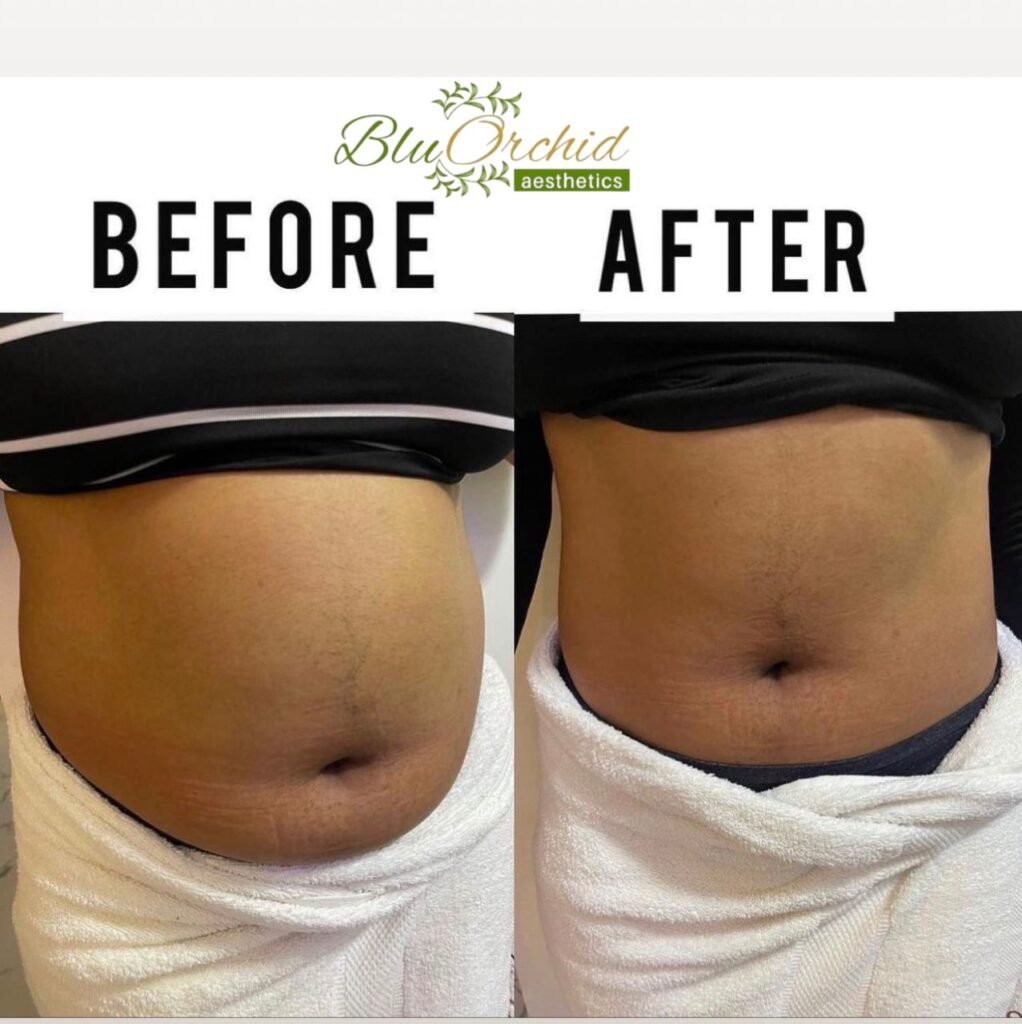 Doctor-led weight loss progress at BluOrchid Aesthetics